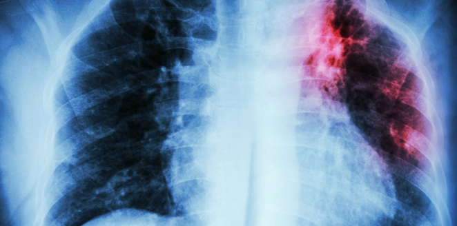 Approach to cystic fibrosis